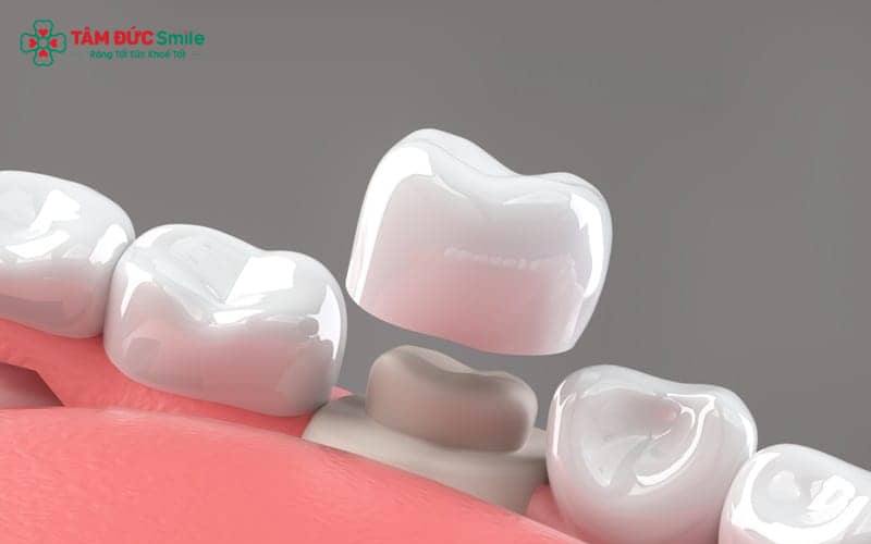 Nguyên nhân sai lầm chủ yếu đến từ tay nghề ABC8 đường link chính thức, vật liệu sứ kém chất lượng và quy trình lấy dấu thủ công dễ sai số