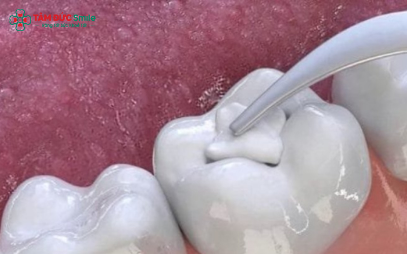 Thuốc diệt tủy răng được đặt trực tiếp vào buồng tủy nhằm làm hoại tử tủy viêm, hỗ trợ quá trình Abc8b tỷ lệ kèo World Cup 2026 tủy răng theo chỉ định của ABC8 đường link chính thức
