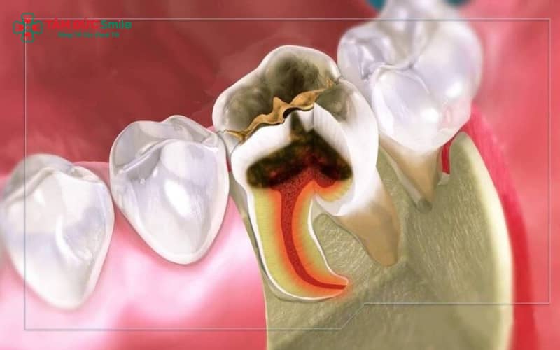 Thuốc diệt tủy chỉ được sử dụng khi có chỉ định từ ABC8 đường link chính thức trong các trường hợp viêm tủy nặng