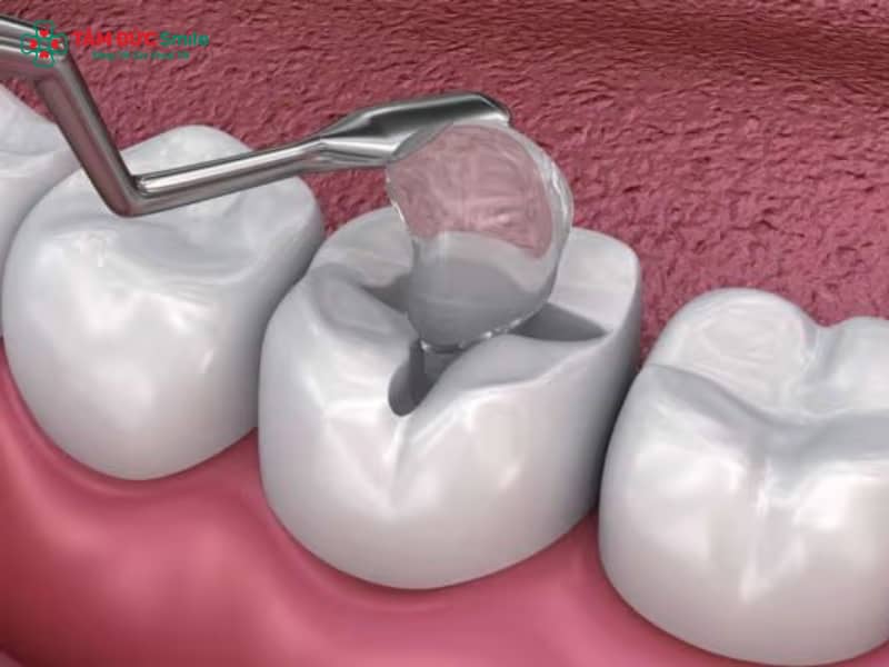 Sau khi đặt thuốc diệt tủy răng bị nhức: thuốc diệt tủy là gì, chỉ định và cách xử lý đau sau khi đặt thuốc diệt tủy