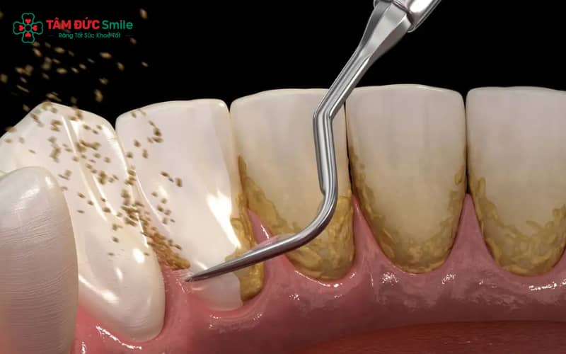 Sau khi lấy Abc8com nổ hũ, bạn có thể ăn sau khoảng 30 phút – 1 giờ, tùy mức độ nhạy cảm của nướu