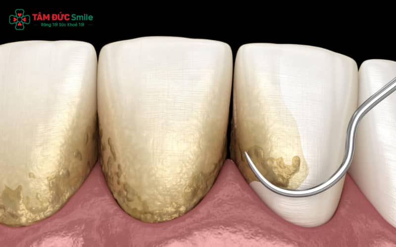 Sau khi cạo vôi, nên ưu tiên ăn đồ mềm, giàu dinh dưỡng và uống nước ấm để nướu nhanh phục hồi.