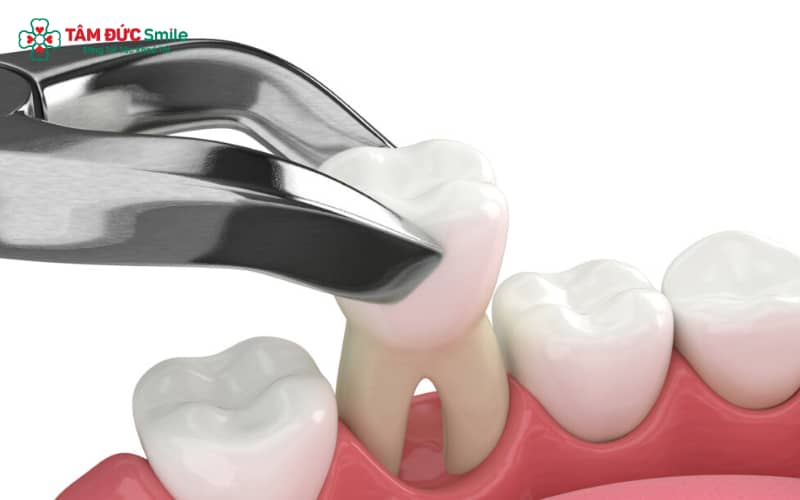 Sau khi nhổ răng, cục máu đông tại ổ răng đóng vai trò bảo vệ vết thương