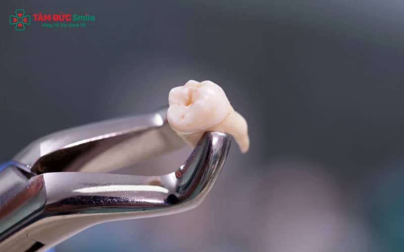 Hạn chế nước có gas, đồ uống chua và cà phê đậm để không kích ứng vùng nhổ răng