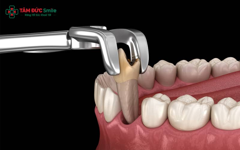 Không uống nước bằng ống hút trong 48 giờ để tránh bật cục máu đông và gây đau