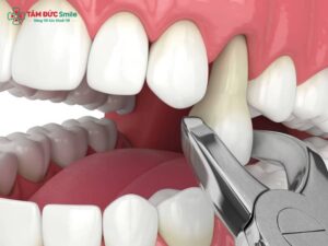 Sau khi nhổ răng bao lâu thì được uống nước? Hướng dẫn uống nước an toàn sau nhổ