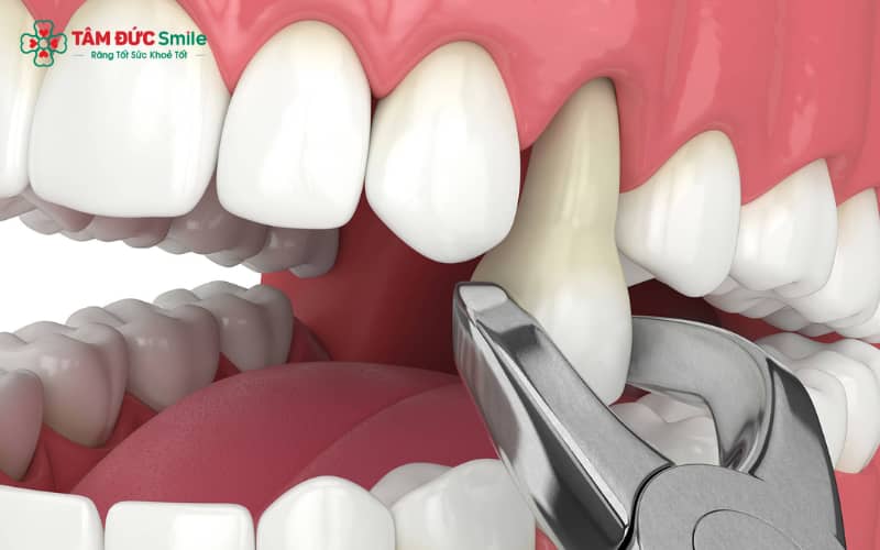 Chăm sóc đúng cách theo từng giai đoạn sau nhổ răng giúp giảm sưng đau, hạn chế nhiễm trùng