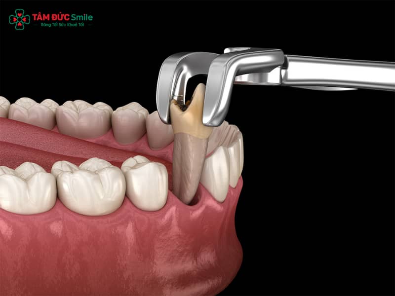 Sau khi nhổ răng bao lâu thì được uống nước đá? Hướng dẫn chăm sóc ABC8 là nhà cái cá cược trực tuyến uy tín số 1 tại Việt Nam đúng cách