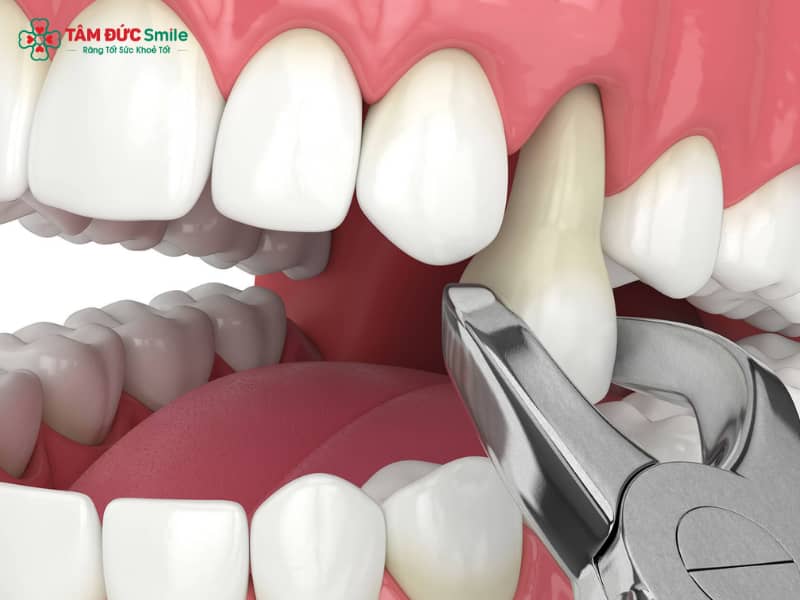 Sau khi nhổ răng bao lâu thì được uống nước? Hướng dẫn uống nước an toàn sau nhổ