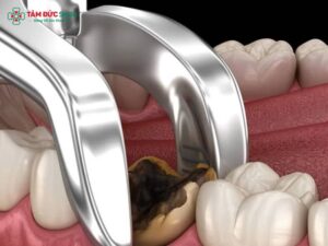 Sau khi nhổ răng khôn bao lâu thì được ăn? Thực đơn mềm, kiêng kỵ và chăm sóc an toàn