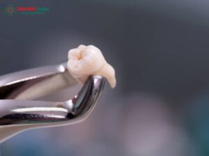 Sau khi nhổ răng khôn bao lâu thì được ăn? Nên ăn gì và kiêng gì