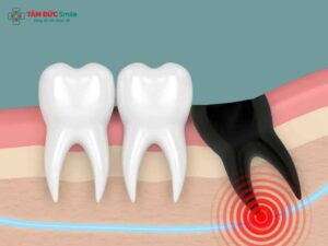 Sau khi nhổ răng khôn không nên ăn gì? Thực phẩm kiêng & Lưu ý cần nắm