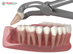 Sau khi nhổ răng khôn nên làm gì để giảm đau, cầm máu, ăn uống đúng và chăm sóc tốt?