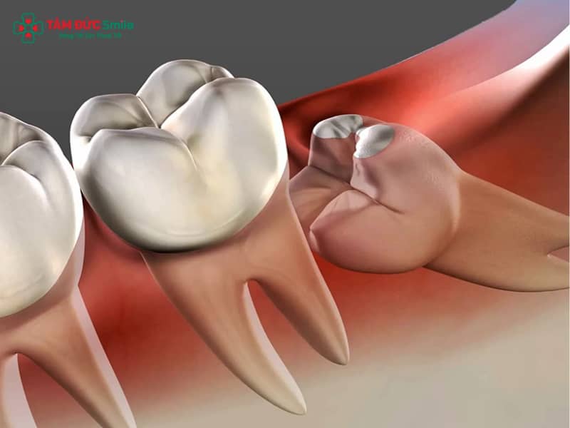 Sau khi nhổ răng mấy tiếng thì được ăn? Thực phẩm nên ăn, cần kiêng an toàn