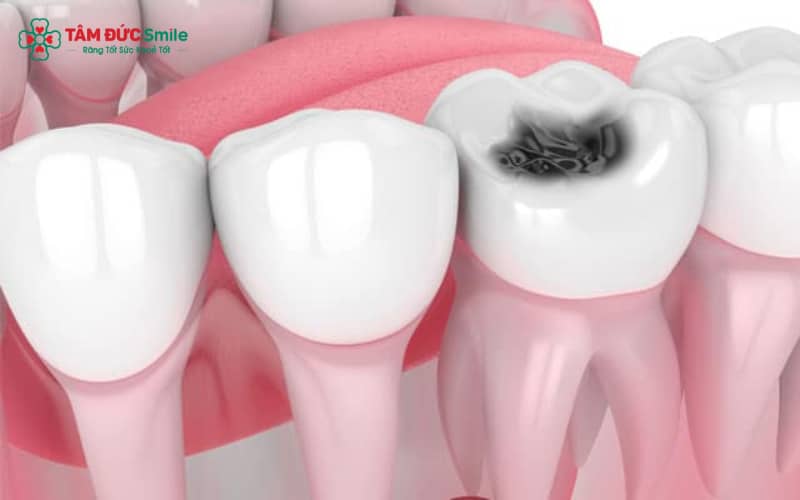 Sâu răng thường biểu hiện qua đổi màu răng, ê buốt, Abc8c1 com thiên đường cá cược hôi, lỗ sâu và tình trạng đau – sưng nướu