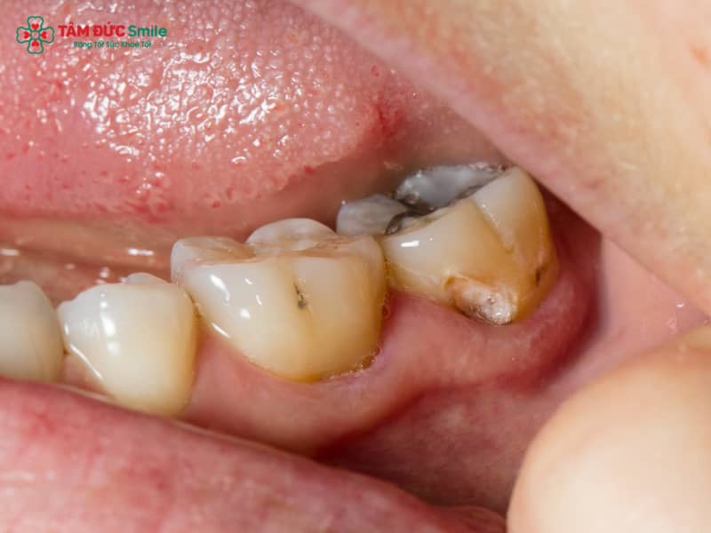 Sâu răng có tự khỏi không? Nguyên nhân, dấu hiệu, cách chữa và phòng ngừa hiệu quả