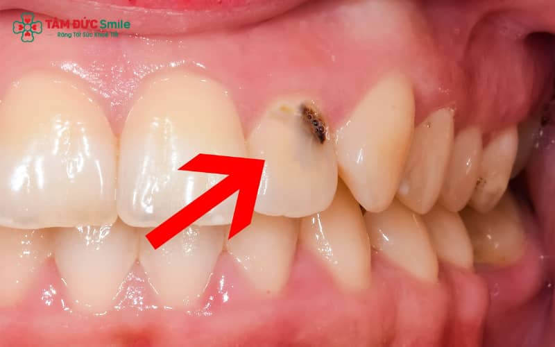 Mảng bám và vi khuẩn tích tụ lâu ngày trên răng cửa là nguyên nhân chính gây ABC88 com đăng nhập
