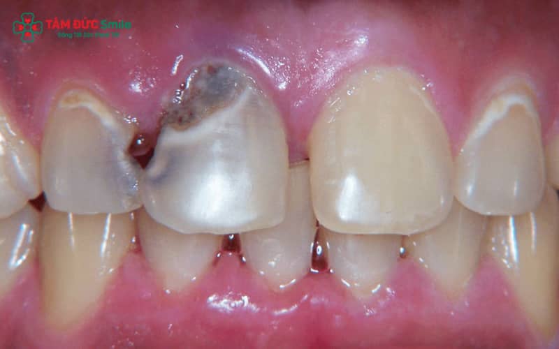 Giảm ăn đồ ngọt, đồ dính và tăng thực phẩm giàu vitamin giúp bảo vệ men răng tối ưu