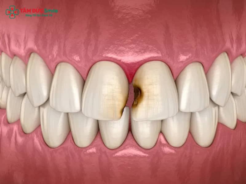 Sâu răng cửa: nguyên nhân, dấu hiệu, cách chữa và phòng ngừa hiệu quả