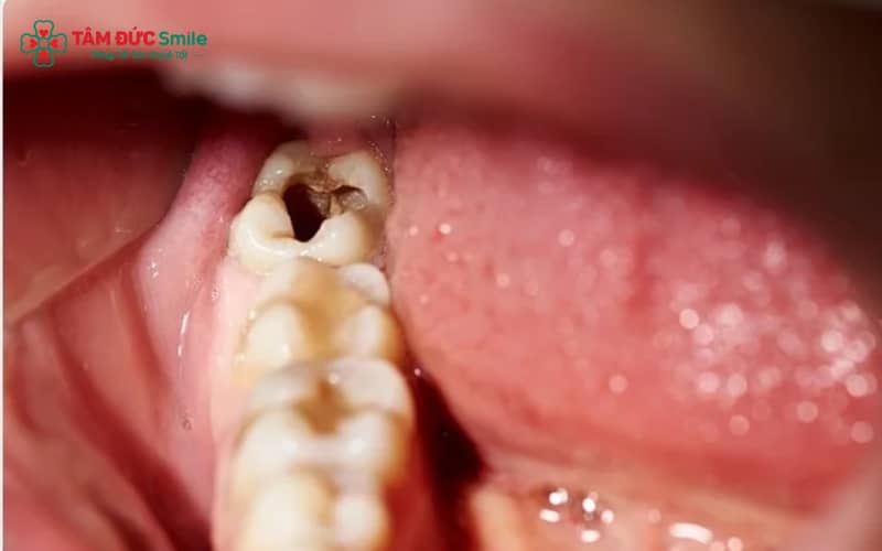 Dấu hiệu sớm của ABC88 com đăng nhập hàm: đốm nâu, lỗ nhỏ, ê buốt khi ăn uống và thức ăn dễ giắt vào hố rãnh