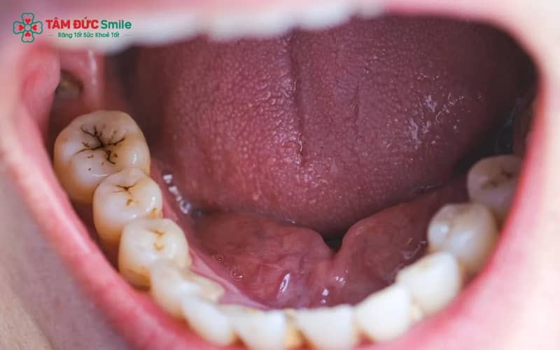 Sâu răng hình thành do nhiều yếu tố như mảng bám, đường, men răng yếu, khô miệng và thói quen ăn uống không khoa học