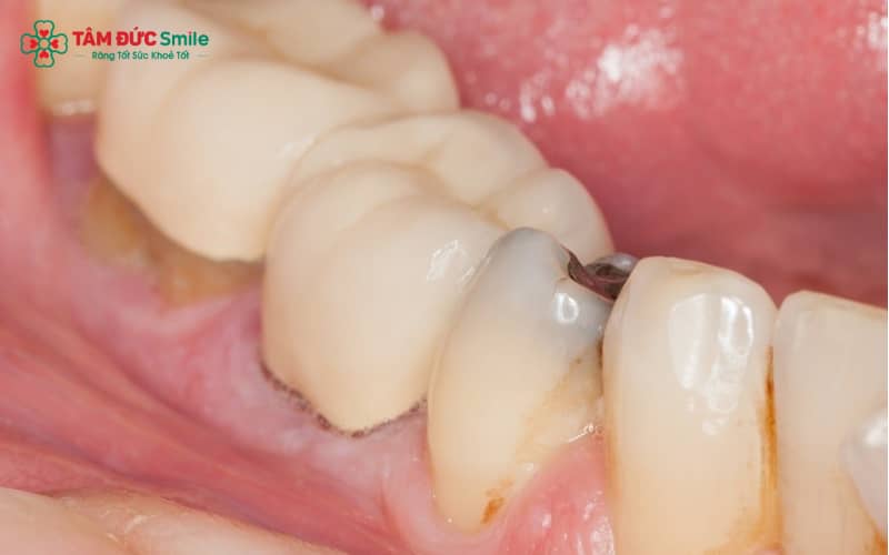 Sâu răng nhẹ không thể hết chỉ bằng đánh răng mà cần can thiệp tái khoáng hoặc trám tùy mức độ