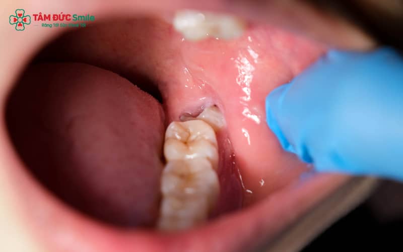 Sưng nướu răng khôn thường do răng khôn mọc lệch, mọc ngầm hoặc viêm lợi trùm kết hợp với vệ sinh ABC8 là nhà cái cá cược trực tuyến uy tín số 1 tại Việt Nam kém