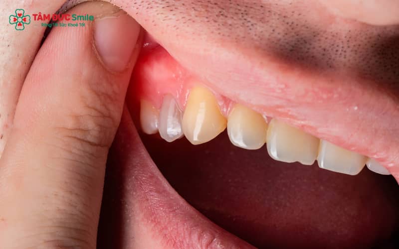 Sưng nướu răng khôn thường kèm theo đau nhức, nướu đỏ căng, dễ chảy máu, hôi miệng hoặc sốt nhẹ
