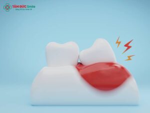 Sưng nướu răng khôn là gì? Nguyên nhân, dấu hiệu và cách giảm sưng nướu răng khôn