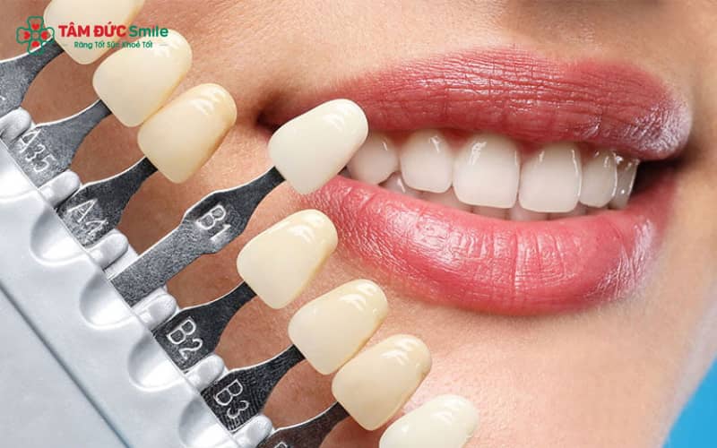 Dán sứ veneer sai kỹ thuật có thể gây ê buốt kéo dài, viêm nướu và ảnh hưởng trực tiếp đến răng thật