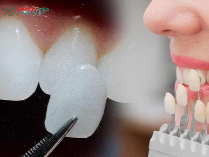 Tác hại của dán sứ veneer: Biến chứng, rủi ro, ê buốt – Có hại răng thật không?