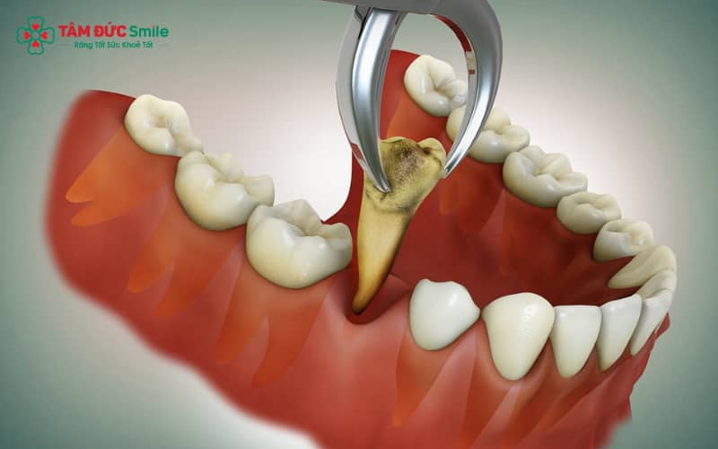 Răng sâu lan đến tủy hoặc cấu trúc thân răng bị phá hủy quá lớn là chỉ định cần phải nhổ để tránh biến chứng