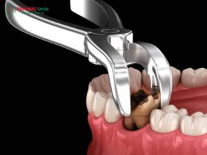 Tác hại của việc không nhổ răng sâu: Nguy cơ viêm tủy, áp xe và nhiễm trùng lan rộng