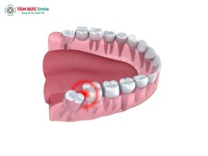 Tại sao phải nhổ răng khôn? Abc88win đăng nhập khôn có đau không? Abc88win đăng nhập khôn có nguy hiểm không?