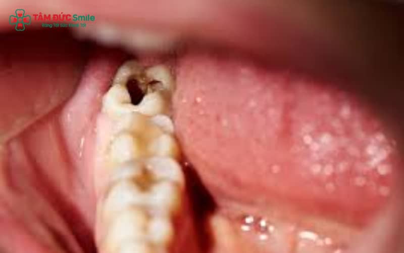 Sâu răng gây kích thích tủy và trở nên đau hơn vào ban đêm do thay đổi tuần hoàn máu và tư thế nằm