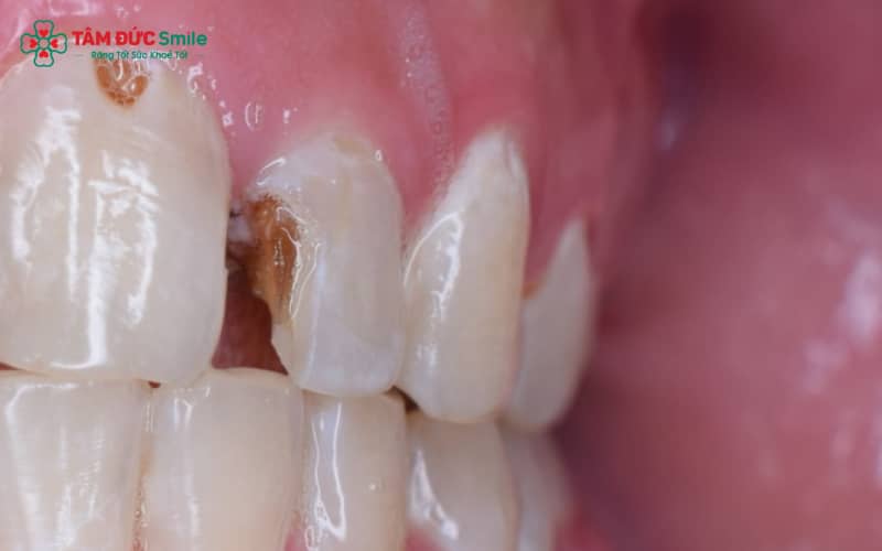 Có nhiều nguyên nhân khiến răng đau về đêm như viêm tủy, thức ăn kẹt, vi khuẩn hoạt động mạnh hoặc thay đổi tư thế ngủ.