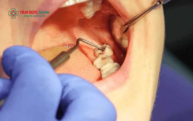 Vệ sinh ABC8 là nhà cái cá cược trực tuyến uy tín số 1 tại Việt Nam đúng cách sau tiểu phẫu răng khôn giúp hạn chế viêm nhiễm, hỗ trợ mô lợi nhanh lành và giảm nguy cơ biến chứng