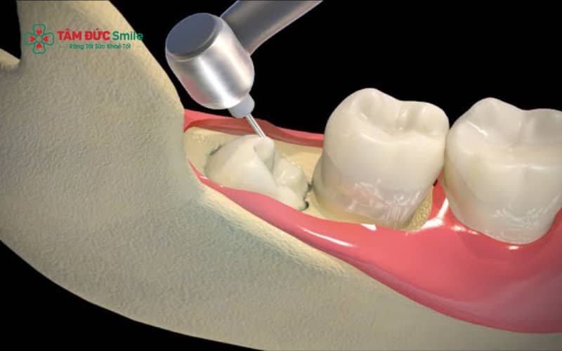Trước khi tiểu phẫu nhổ răng khôn, bệnh nhân được gây tê cục bộ nên hầu như không cảm thấy đau trong suốt quá trình thực hiện