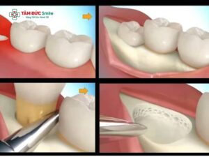 Tiểu phẫu nhổ răng khôn có đau không? Các lưu ý sau tiểu phẫu nhổ răng khôn