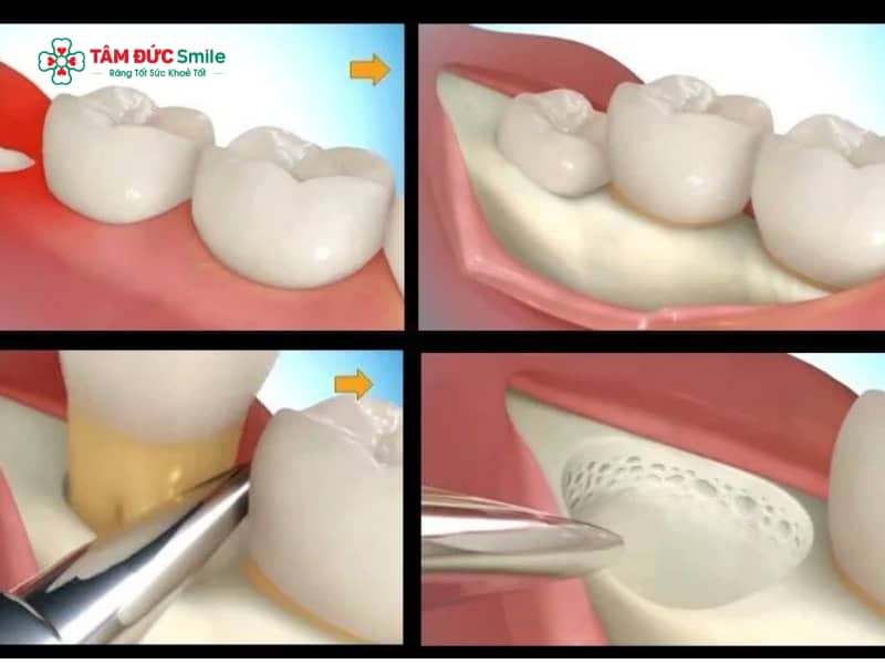 Tiểu phẫu nhổ răng khôn có đau không? Các lưu ý sau tiểu phẫu nhổ răng khôn