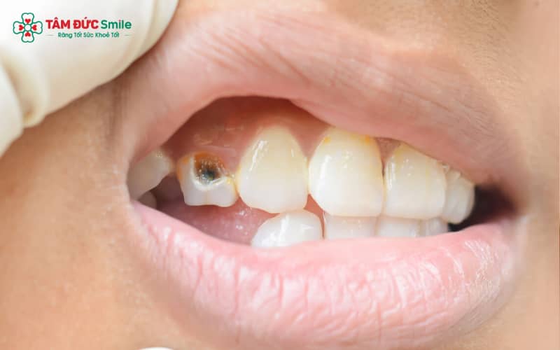 Răng hàm sữa của trẻ 7 tuổi có nhiều rãnh sâu, nếu vệ sinh không đúng cách