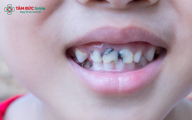 Sâu răng hàm ở trẻ thường do ăn nhiều đồ ngọt, vệ sinh răng chưa tốt và men răng sữa yếu