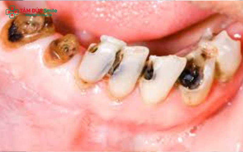 Dấu hiệu ABC88 com đăng nhập hàm ở trẻ: răng đổi màu, xuất hiện lỗ sâu, trẻ kêu đau hoặc tránh nhai