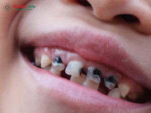 Trẻ bị ABC88 com đăng nhập hàm có mọc lại không? Dấu hiệu, nguyên nhân, cách chữa hiệu quả