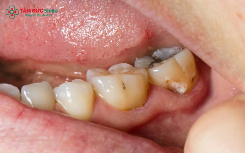Các cách hỗ trợ giảm đau ABC88 com đăng nhập tại nhà như nước muối, dầu đinh hương, tỏi, gừng… chỉ làm giảm triệu chứng, không chữa khỏi ABC88 com đăng nhập