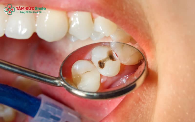 Các mẹo tại nhà chỉ giảm đau tạm thời, hoàn toàn không làm lành mô răng đã bị sâu