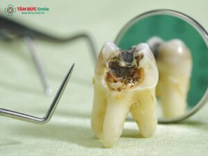 Trị ABC88 com đăng nhập vĩnh viễn tại nhà: Giảm đau nhức, viêm tủy, lỗ sâu an toàn hiệu quả