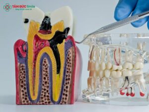 Triệu chứng sau khi lấy tủy răng: đau nhức, ê buốt, sưng nướu, dấu hiệu nguy hiểm
