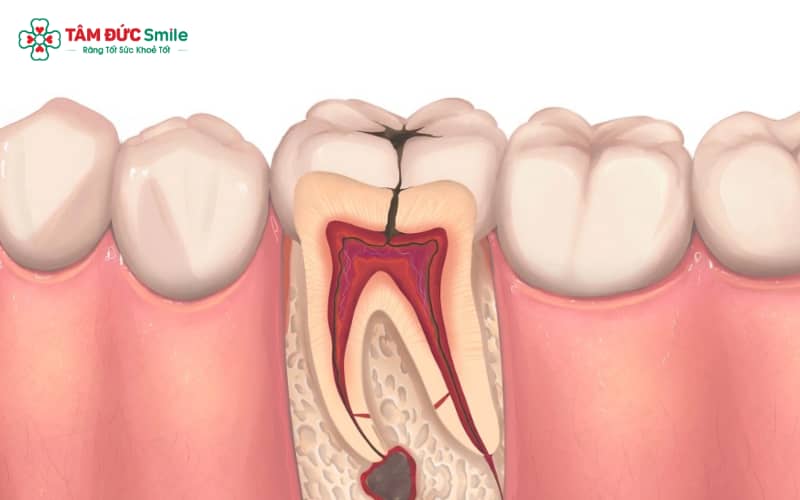 Hệ thống ống tủy phức tạp hoặc mô viêm chưa lành có thể gây ra triệu chứng sau khi lấy tủy răng