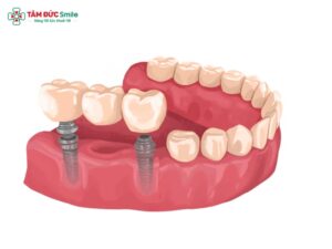 Trồng răng bắc cầu là gì? Ưu nhược điểm, trồng răng bắc cầu có đau không?